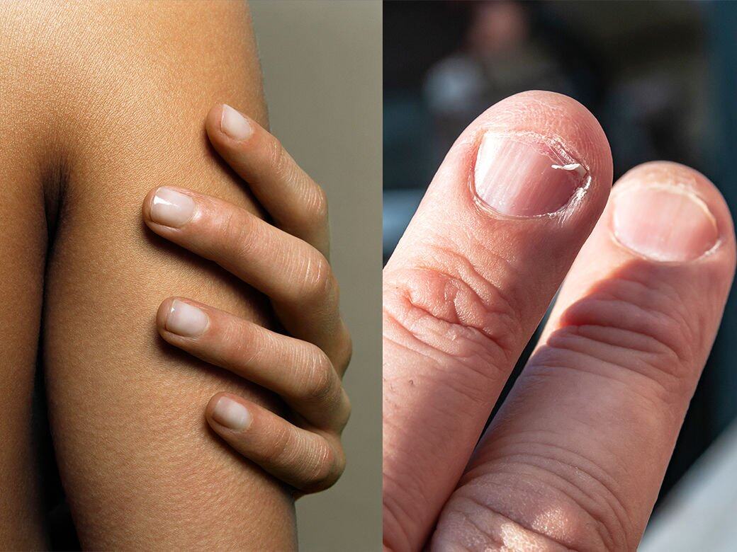 指甲出紋、反甲、黑點代表有毛病！指甲如何反映健康？教你從4個指甲健康狀況看出身體毛病