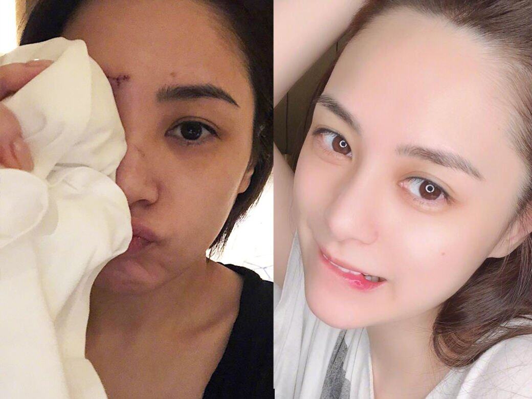 必學正確除疤方法!9款有效去疤膏、除疤啫喱、除疤貼推介:疤痕敵、喜療疤、倍舒痕! 必學正確除疤方法!9款有效去疤膏、除疤啫喱、除疤貼推介:疤痕敵、喜療疤、倍舒痕!