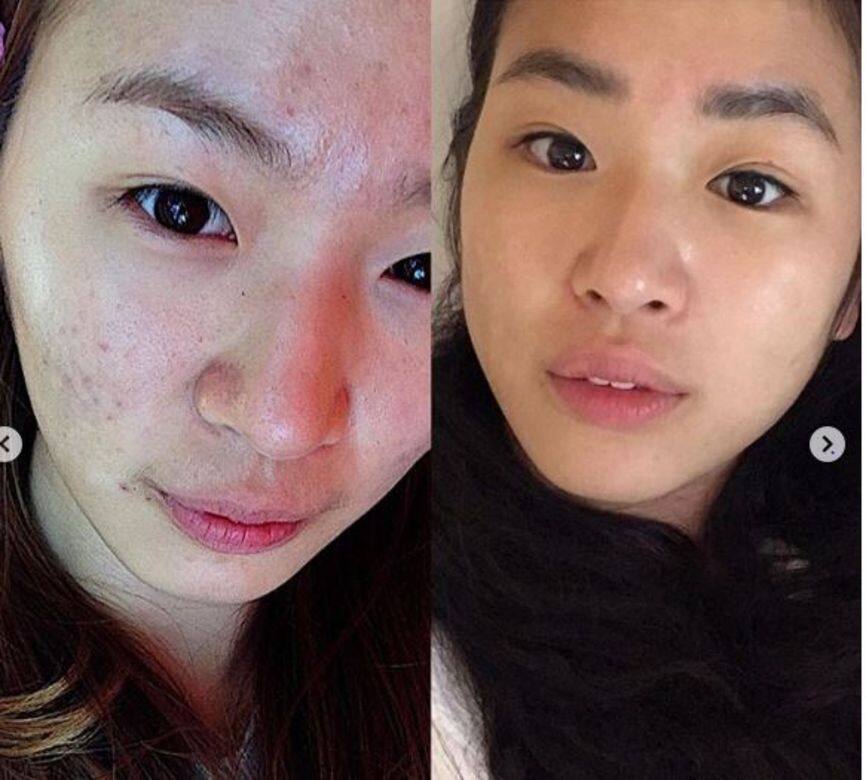 原本她的臉上,留下不少暗瘡疤痕,崔高恩在沒有激光治療的情況下,每天 原本她的臉上,留下不少暗瘡疤痕,崔高恩在沒有激光治療的情況下,每天