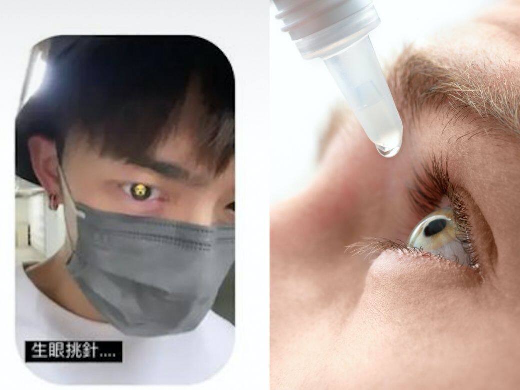 眼瘡藥膏及藥水推薦!預防眼挑針反覆返發消炎建議 眼瘡藥膏及藥水推薦!預防眼挑針反覆返發消炎建議
