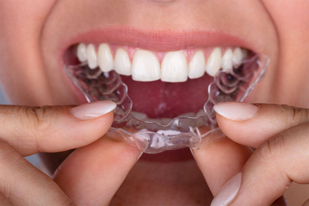近年相繼有其他品牌開始提供隱形牙套的治療方案，除了耳熟能詳的隱