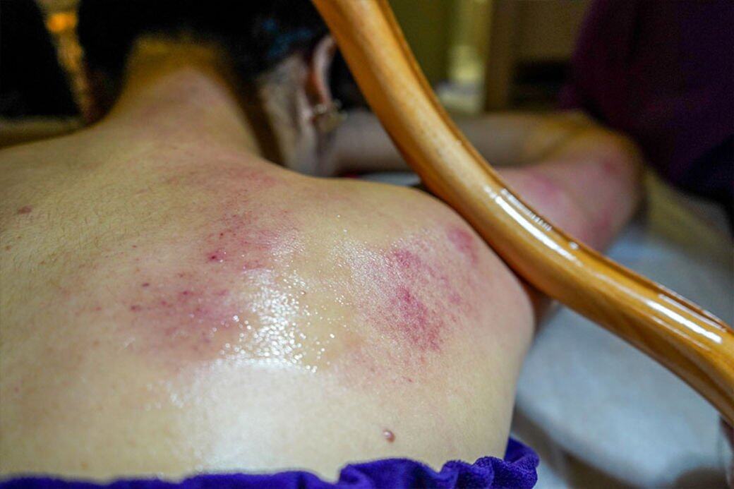 這種spa有點像一般所知的「刮砂」,因應個人情況治療完身體會出現不同深 這種spa有點像一般所知的「刮砂」,因應個人情況治療完身體會出現不同深