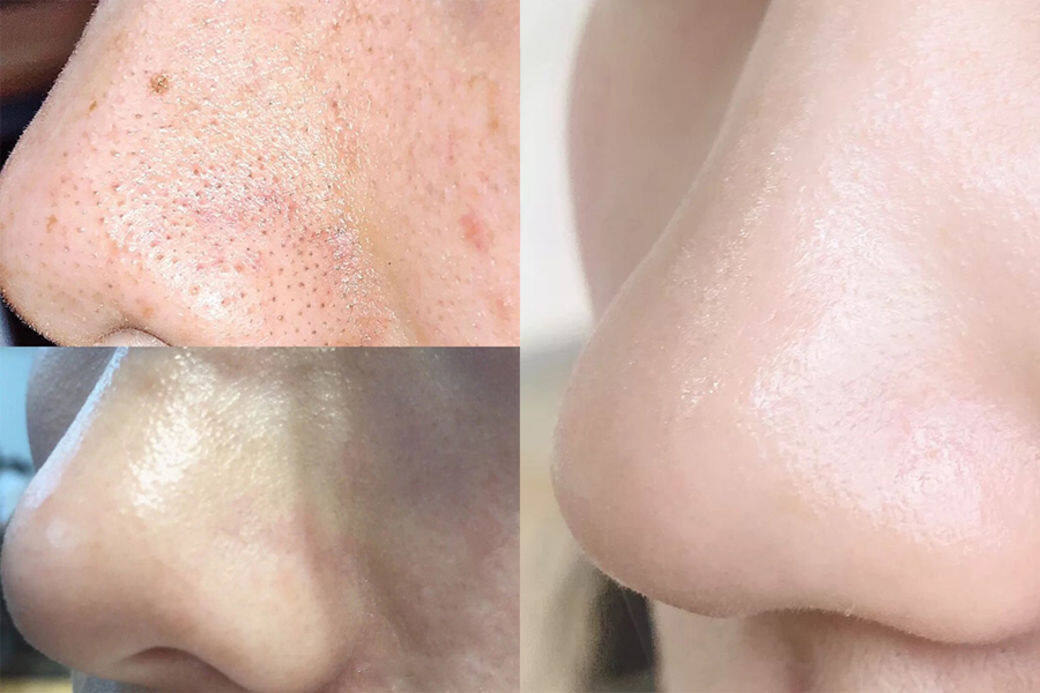 教你在家Facial!簡單4步成功擊退士多啤梨鼻,清走黑頭收毛孔 教你在家Facial!簡單4步成功擊退士多啤梨鼻,清走黑頭收毛孔