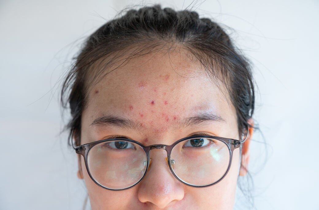 暗粒即「閉合性粉刺」,摸起來是表皮上凸起顆狀物,跟膚色顏色近似,暗粒沒 暗粒即「閉合性粉刺」,摸起來是表皮上凸起顆狀物,跟膚色顏色近似,暗粒沒