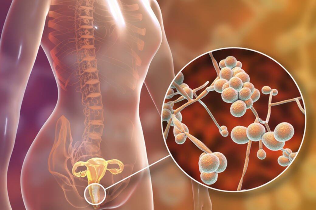 感染念珠菌陰道炎大多數多出現孕婦、長期使用抗生素、還有糖尿病人等
