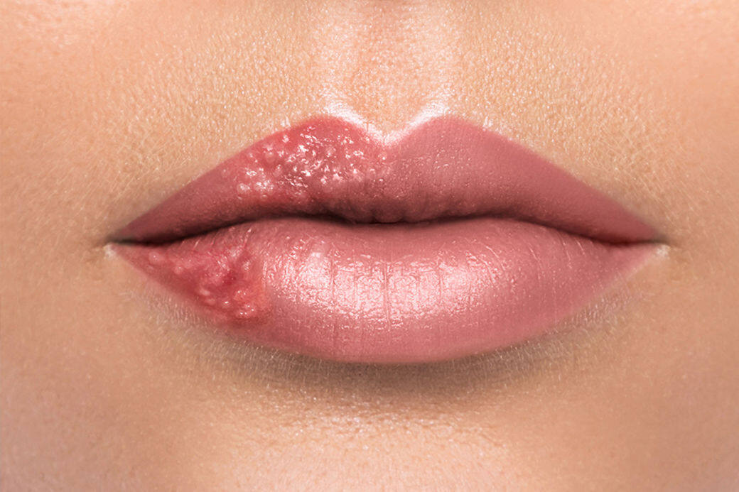 形成唇瘡的主因，是受到疱疹一型病毒感染而形成的，通常在嘴唇和鼻孔