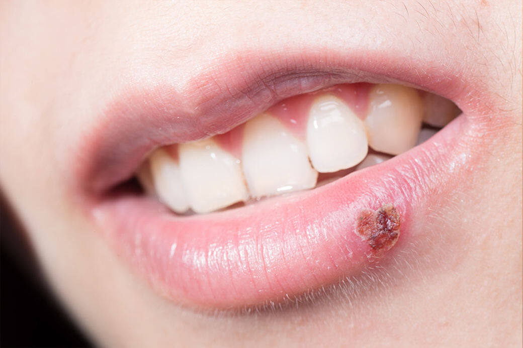 生唇瘡通常會維持7至10天，生唇瘡初期主要會感到雙唇痕癢、刺痛而且