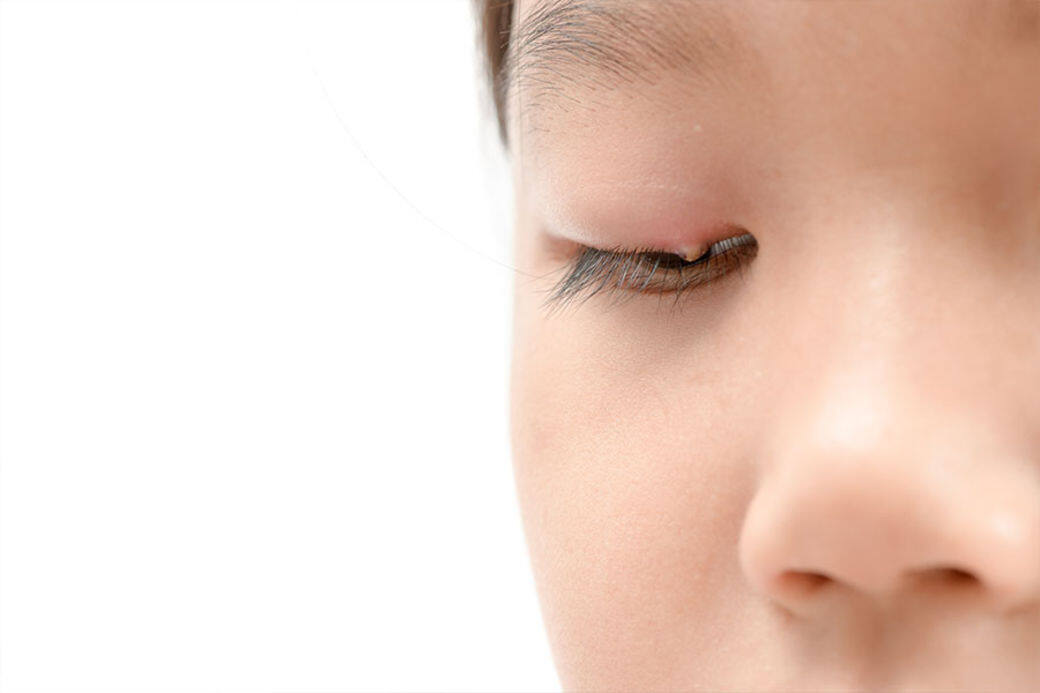 如果一直不好好處理眼瘡，可能會引發皮膚發炎的併發症，出現紅腫及疼