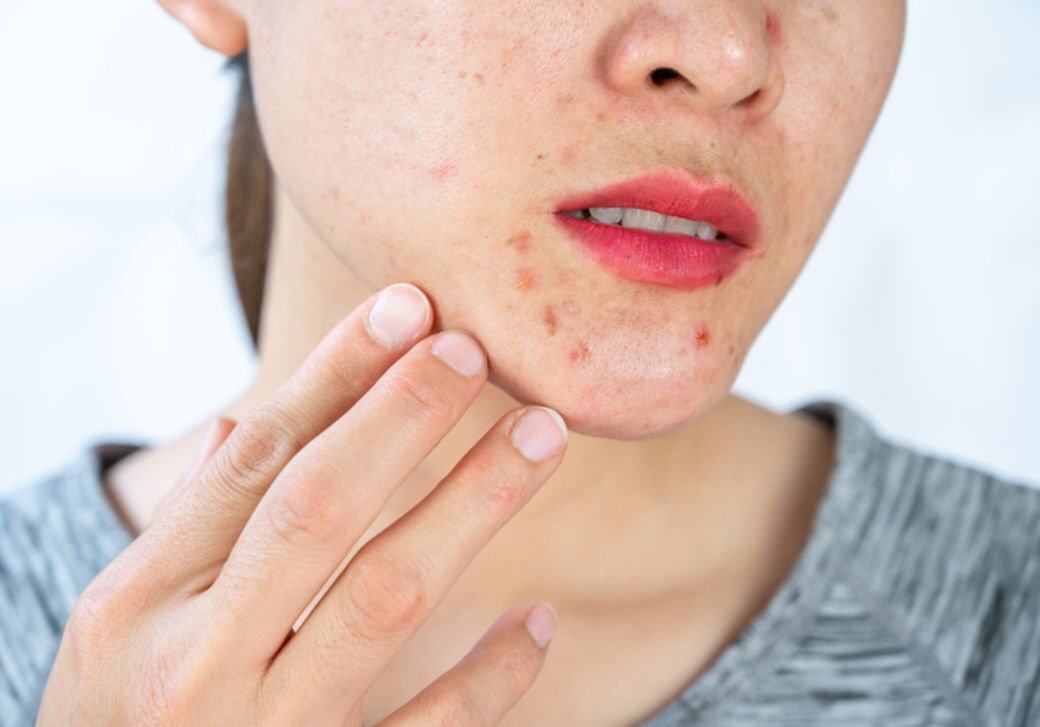 另外,有青春痘或肌膚發炎、過敏的人自己脫面毛很可能會令症狀惡化,如 另外,有青春痘或肌膚發炎、過敏的人自己脫面毛很可能會令症狀惡化,如