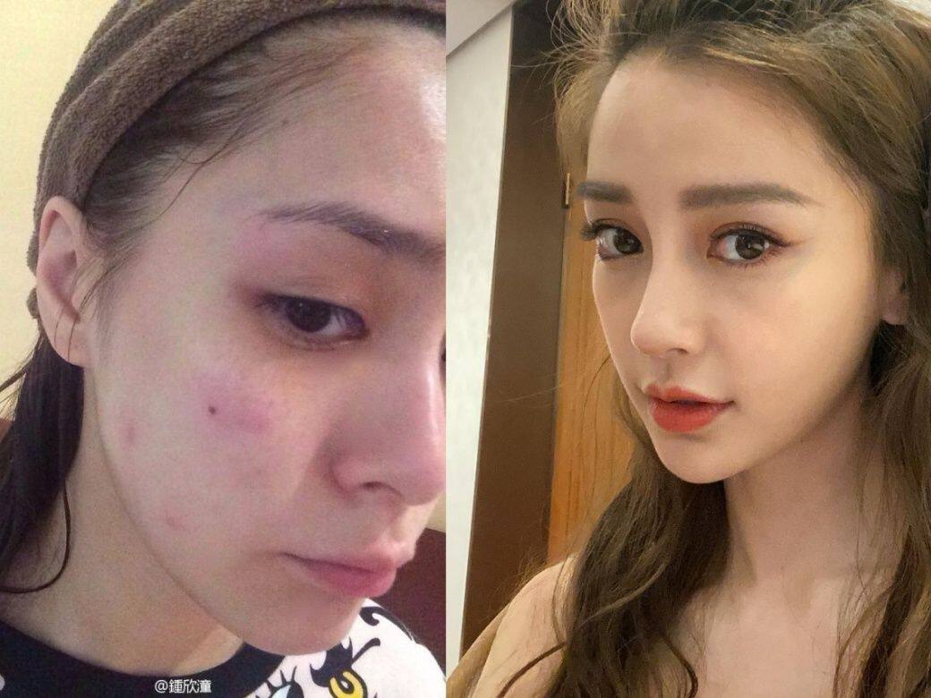 暗瘡位置重要的性!額頭、下巴生瘡14個暗瘡位置提示身體毛病!解決暗瘡要知的生瘡原因及對應清熱去印方法 暗瘡位置重要的性!額頭、下巴生瘡14個暗瘡位置提示身體毛病!解決暗瘡要知的生瘡原因及對應清熱去印方法