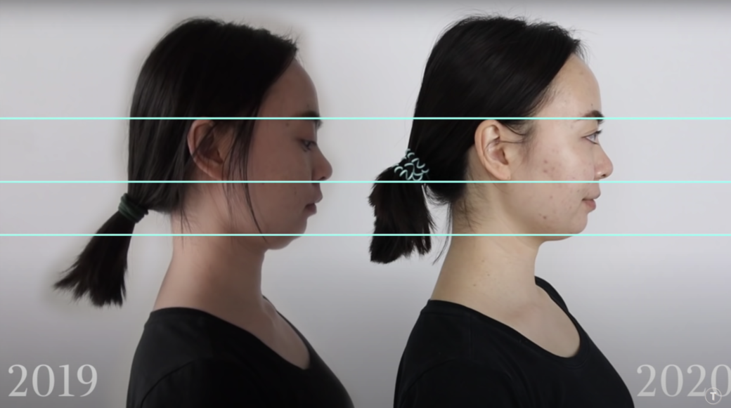 網上能找到不少外國YouTuber都持續進行了Mewing挑戰,而且有些人一個月便看得 網上能找到不少外國YouTuber都持續進行了Mewing挑戰,而且有些人一個月便看得