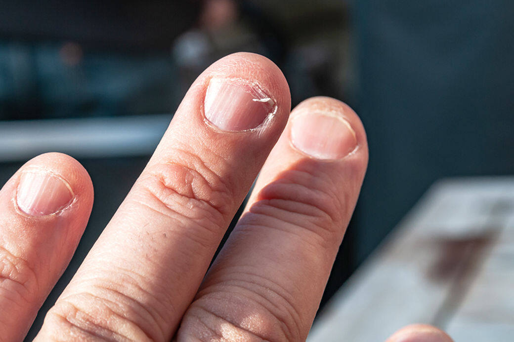 有些人習慣把指甲留得長長的，然而當指甲過長但缺乏營養，便會容易在