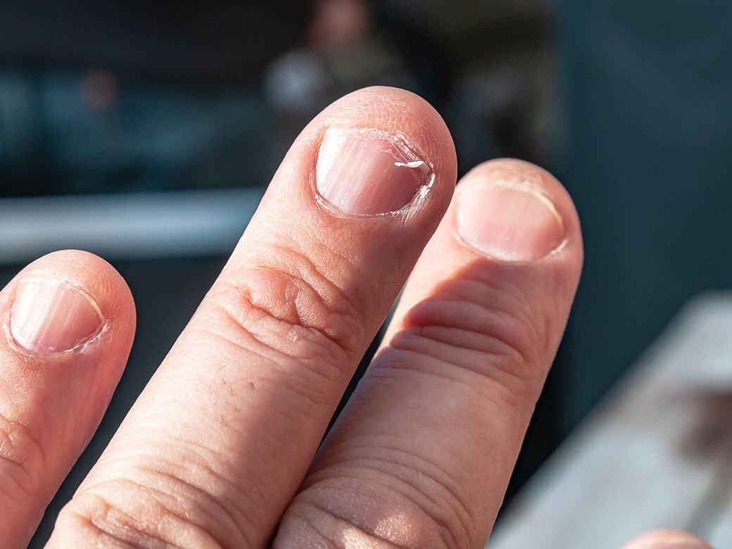 指甲缺乏鐵質會容易出現反甲、斷甲問題，長久亦會令指甲變薄、易折斷及