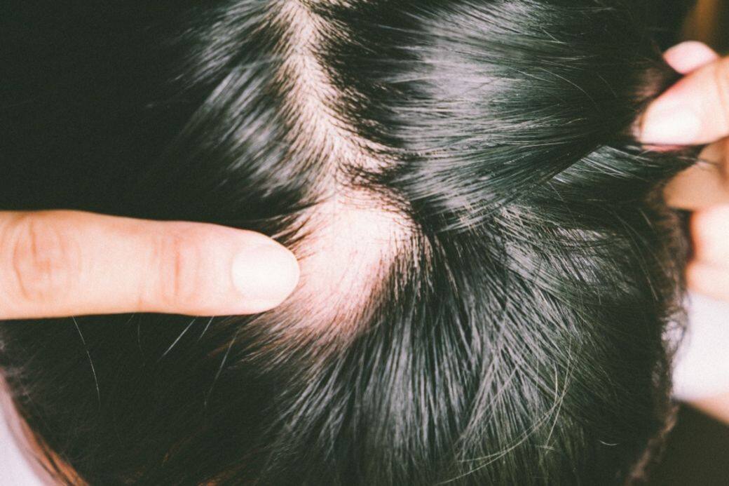 俗稱「鬼剃頭」,任何年紀都有機會遇到,一般認為和免疫系統失調有關,讓自 俗稱「鬼剃頭」,任何年紀都有機會遇到,一般認為和免疫系統失調有關,讓自