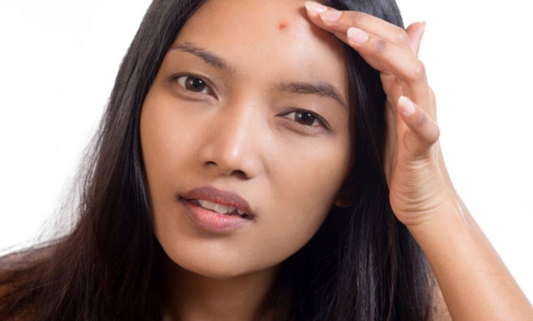 暗瘡, 護膚, 涌潔, skincare 暗瘡, 護膚, 涌潔, skincare