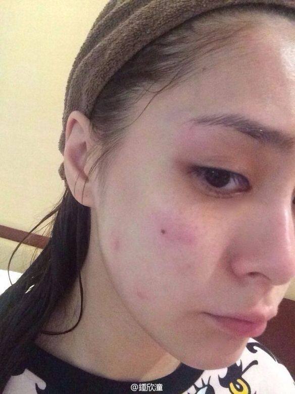 下巴暗瘡下巴石頭瘡到底要如何解決?對於頸部生暗瘡或淋巴位生瘡又 下巴暗瘡下巴石頭瘡到底要如何解決?對於頸部生暗瘡或淋巴位生瘡又