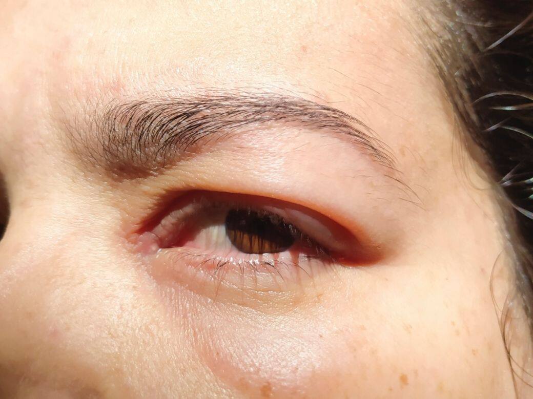 如果瞼板腺因油脂分泌過分旺盛而堵塞,在缺少日常清潔或受細菌感染 如果瞼板腺因油脂分泌過分旺盛而堵塞,在缺少日常清潔或受細菌感染