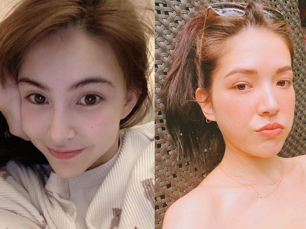 如何有效解決額頭生粒粒面腫問題?皮膚科醫生教你4個有效方法處理皮膚暗粒黑頭油脂粒 如何有效解決額頭生粒粒面腫問題?皮膚科醫生教你4個有效方法處理皮膚暗粒黑頭油脂粒