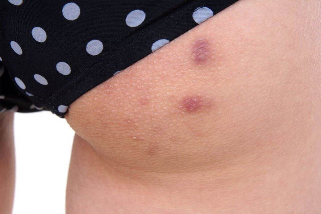 Idriss醫生指出，臂部皮膚不時冒出的小顆粒可能不是暗瘡或痤瘡，而是毛囊