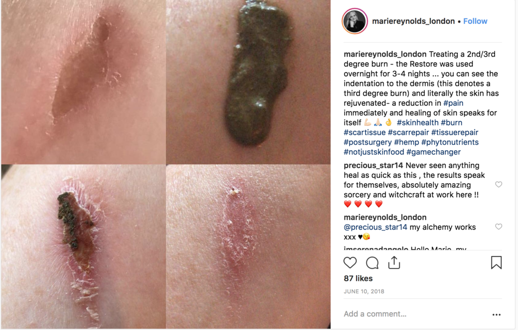 Marie Reynolds London在IG上載不少成功例子,當中有單用Restore面膜重塑微生物平衡的,也 Marie Reynolds London在IG上載不少成功例子,當中有單用Restore面膜重塑微生物平衡的,也