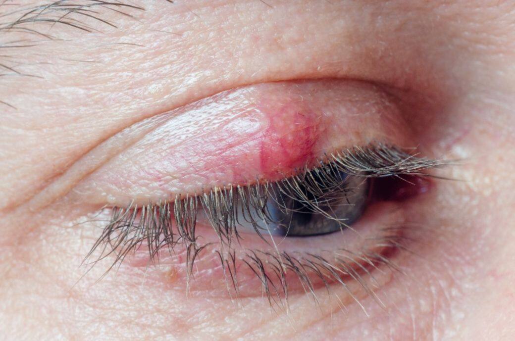 初期的眼挑針問題，可透過醫生處方的抗生素和消炎藥物，如眼藥水或眼