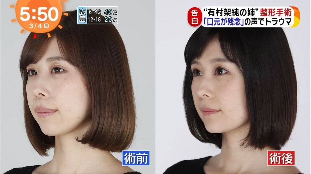 她表示家人相當支持她整容的決定,據指她先拔了6顆牙齒,經過矯正後 她表示家人相當支持她整容的決定,據指她先拔了6顆牙齒,經過矯正後