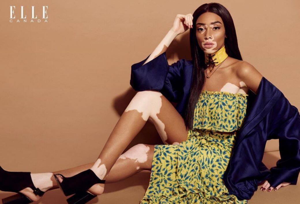 Winnie Harlow, 白蝕症, 超級名模生死鬥, 皮膚病, 模特兒 Winnie Harlow, 白蝕症, 超級名模生死鬥, 皮膚病, 模特兒