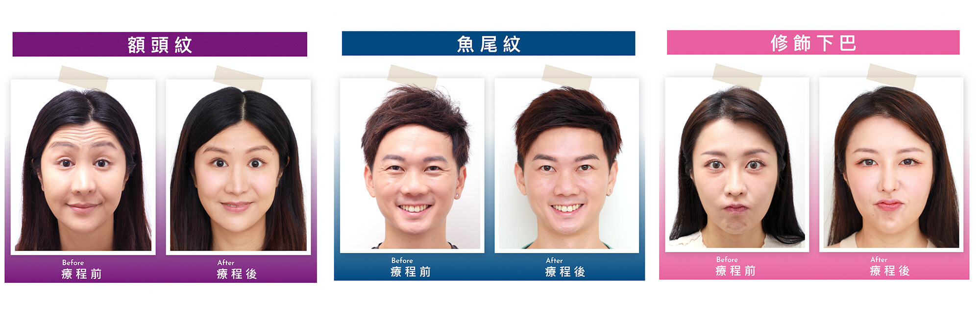 打Botox邊間好 ？ 一文看清香港Botox瘦面去皺價錢、效果及10點必須注意