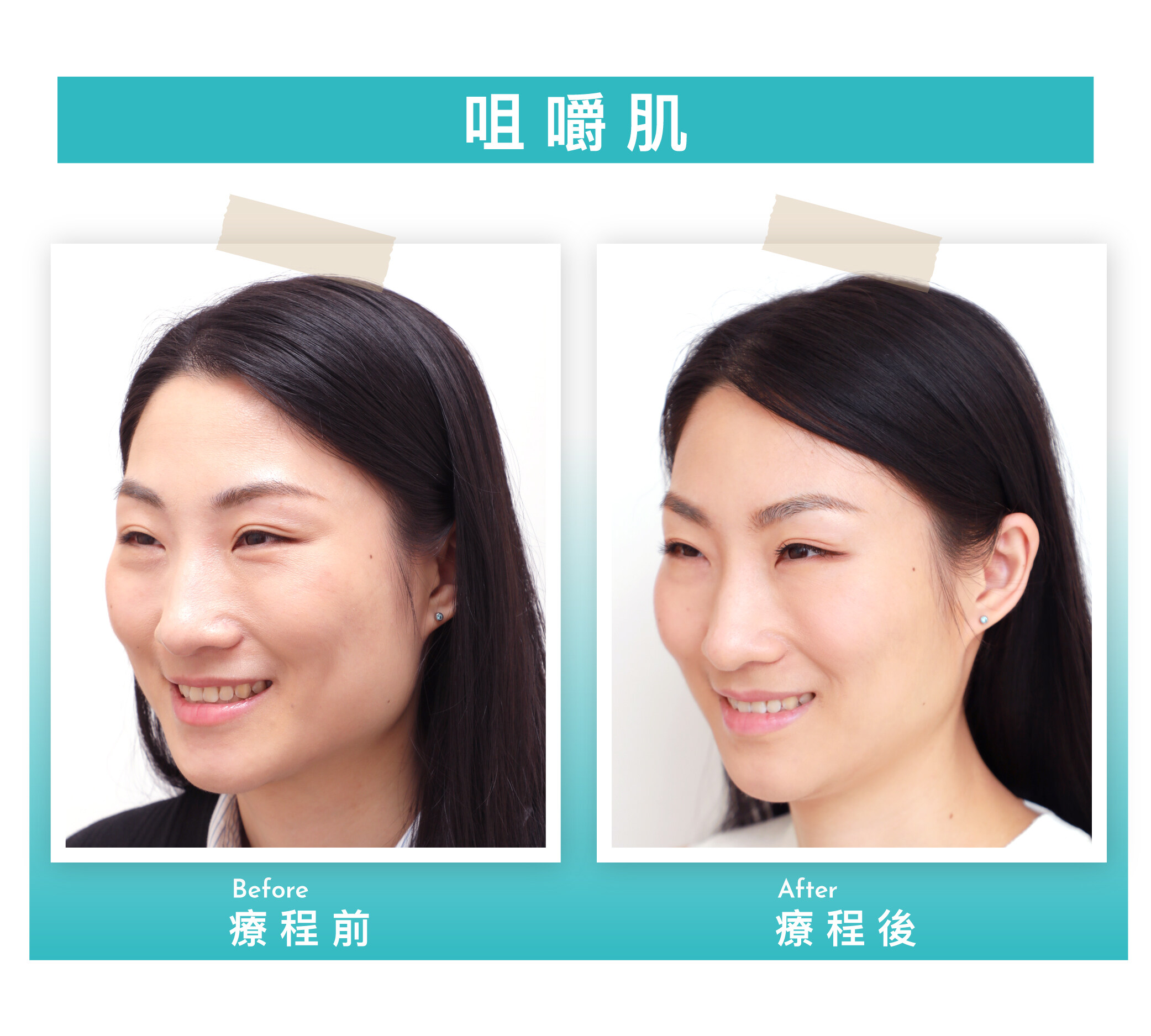 打Botox邊間好 ？ 一文看清香港Botox瘦面去皺價錢、效果及10點必須注意