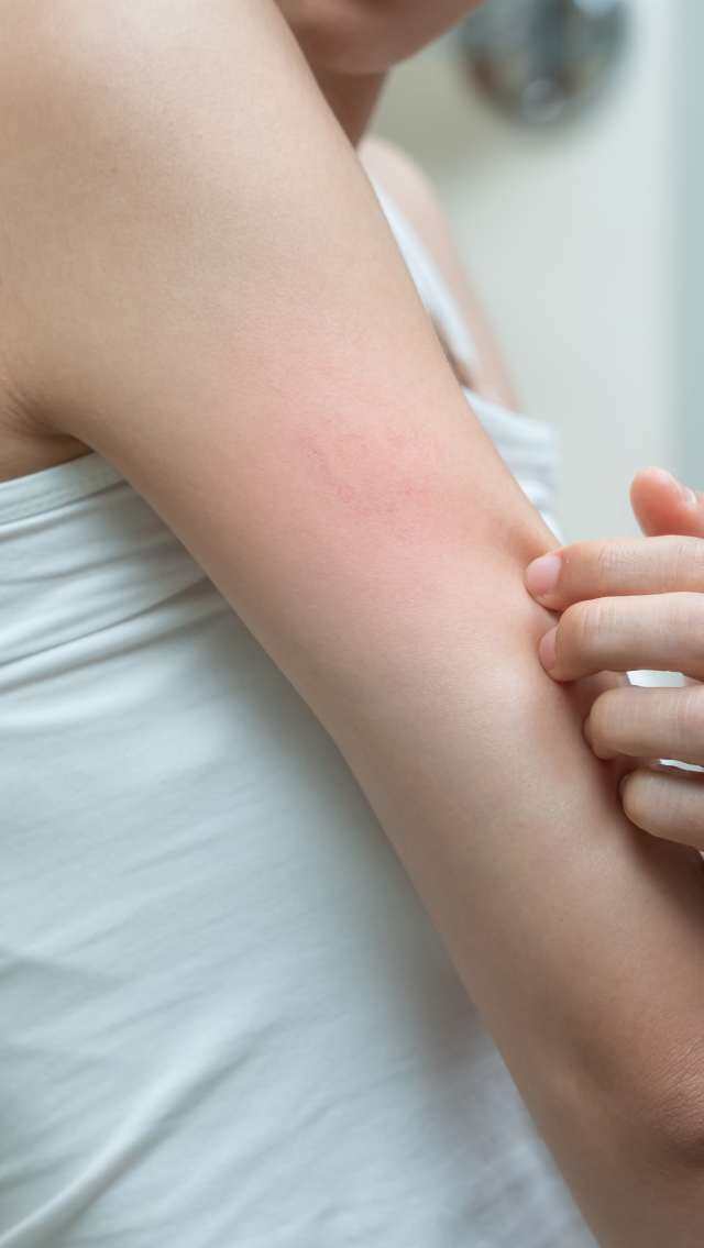 不是皮膚敏感！皮膚科醫生解答玫瑰痤瘡成因和預防方法