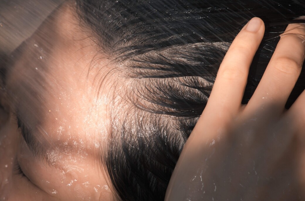 頭皮濕疹症狀認識與護理！如何判斷是不是濕疹？