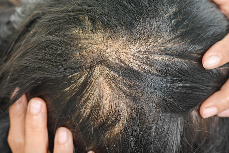 頭皮油脂過盛是造成頭髮稀疏原因之一，由於頭皮的油脂太多會堵塞毛