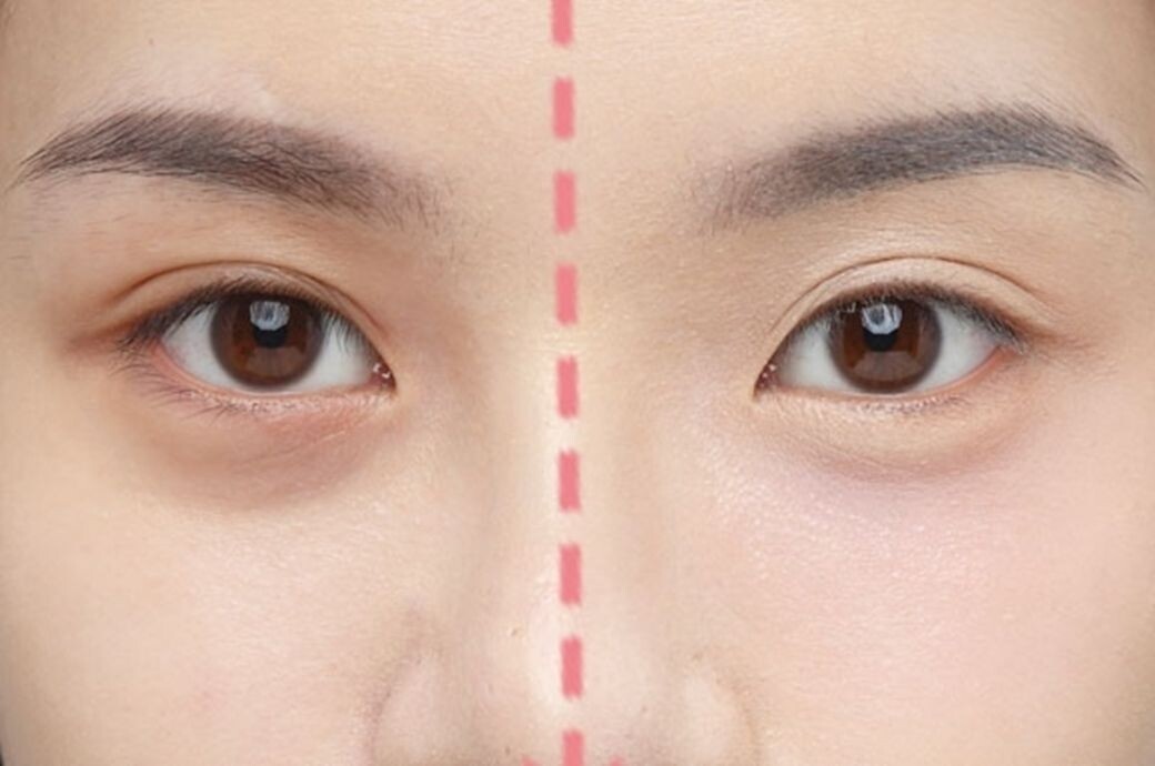 利用膏狀胭脂或唇膏在淚溝位置輕拍遮瑕後，就會發現眼睛下方有明顯