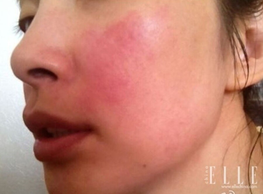 李冰冰也曾經在微博上發布她經歷皮膚敏感時的照片，可以看出她的臉