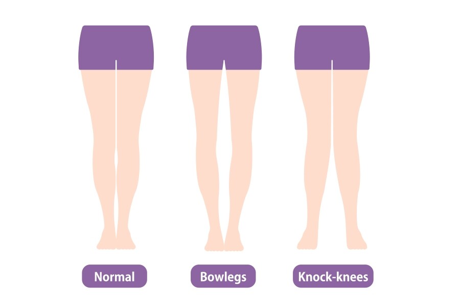 要分析自己屬於哪種腿型，可以站在鏡子前自我檢測一下。雙腳站立時，膝