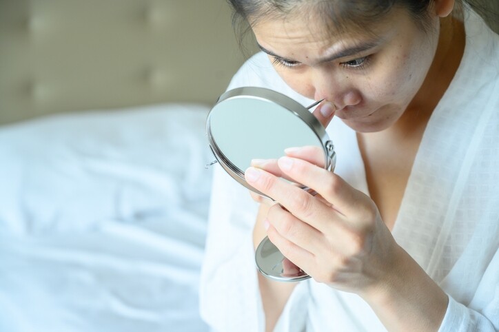 酒糟鼻是一種慢性的皮膚炎症，由於鼻子上的毛孔大而且凹凸不平，細菌