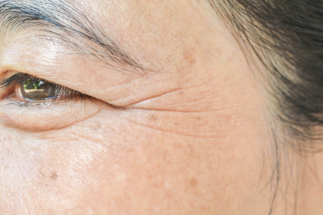 眼部肌膚格外脆弱，近6成人的皺紋最先出現於眼角，其次為前額和其他