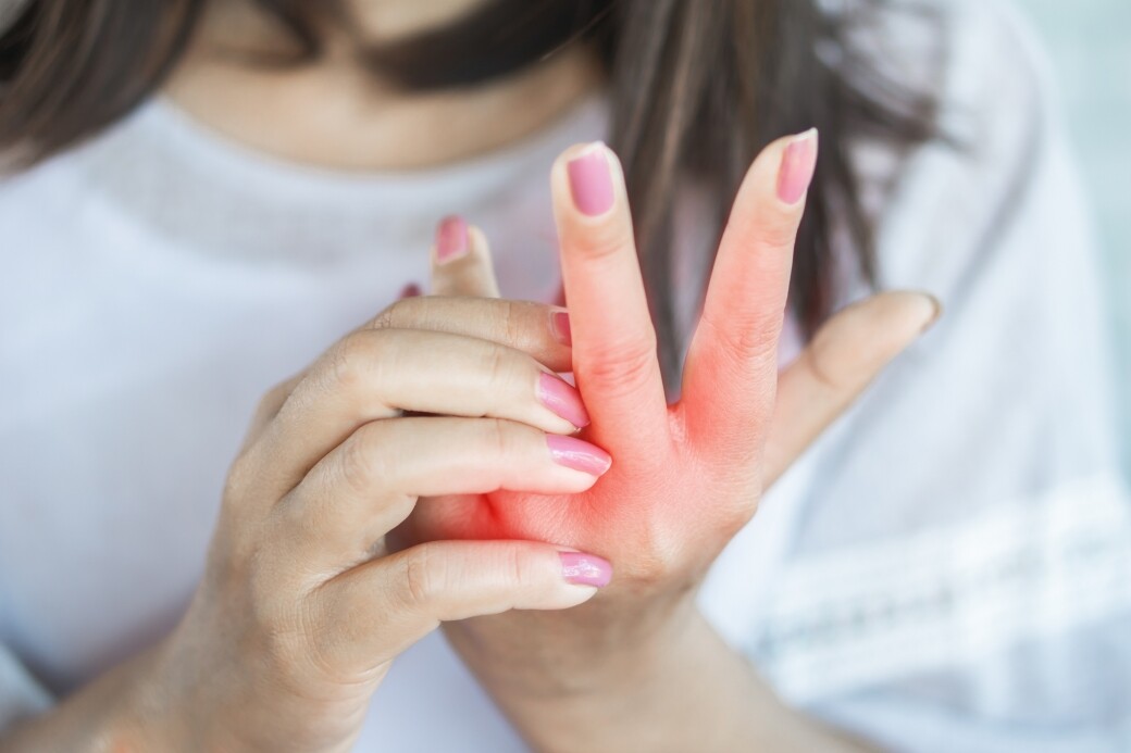 林醫生指主婦手患者的手部皮膚通常都會出現紅腫情況，而且亦會有脫