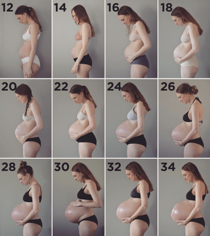 由於懷孕時腹直肌及中間的白線會因為胎兒生長期間而被長時間拉扯