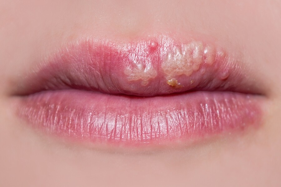 唇瘡一般不會傳染，不過若由皰疹病毒（HSV）引起就具有傳染性，即是唇皰疹