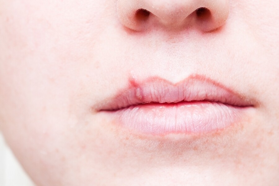 即使不是唇皰疹，刺穿唇瘡也可能造成傷口發生二次感染。有人也會選擇