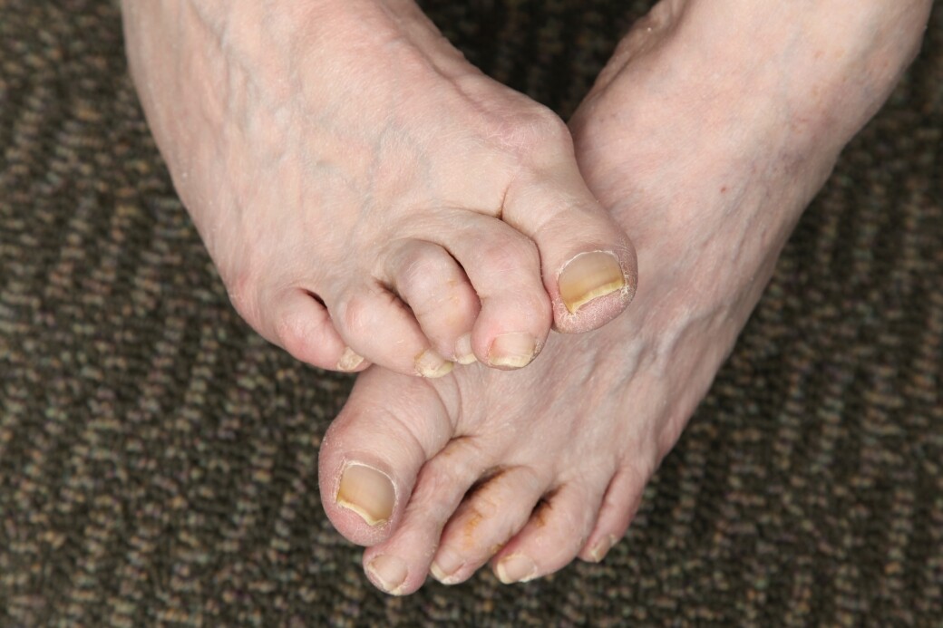 灰甲初期徵狀是指甲顏色會變白、灰、或啡色，有機會有指甲及甲床分離的