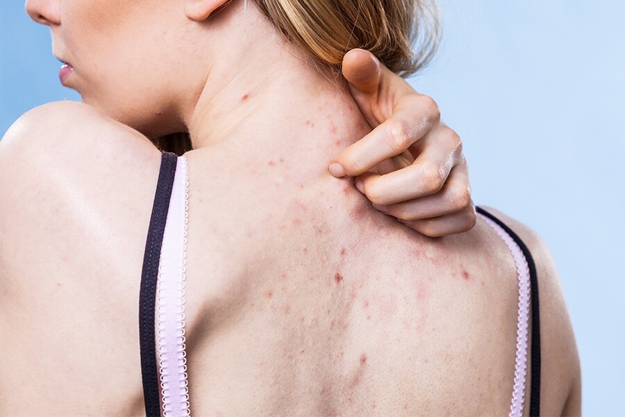 背部暗瘡成因眾多，當中與皮脂分泌、生活壓力、寢具及個人衛生等多方面