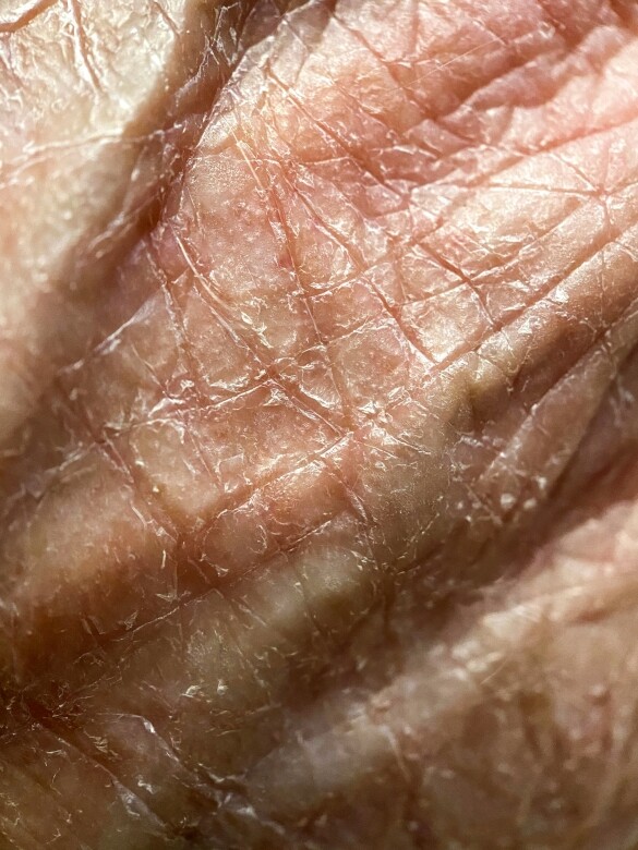 當肌膚底層缺水，會促使肌膚分泌過多油脂去保護及滋潤肌膚，從而讓油