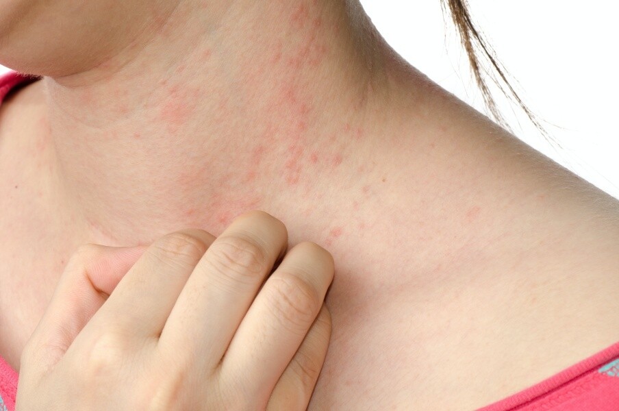 皮膚痕癢粒粒、一撻撻敏症出現時，到底是轉季皮膚敏感，還是濕疹？