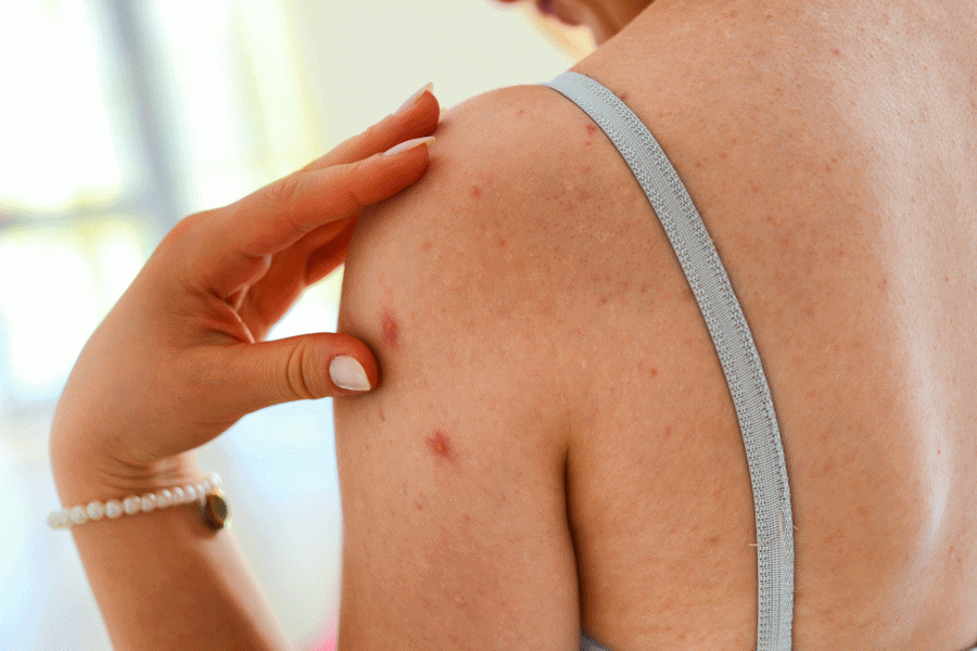 原來背部暗瘡成因除了與肌膚皮脂分泌有關，生活壓力或身體排毒功能欠佳也會引致背部暗瘡。