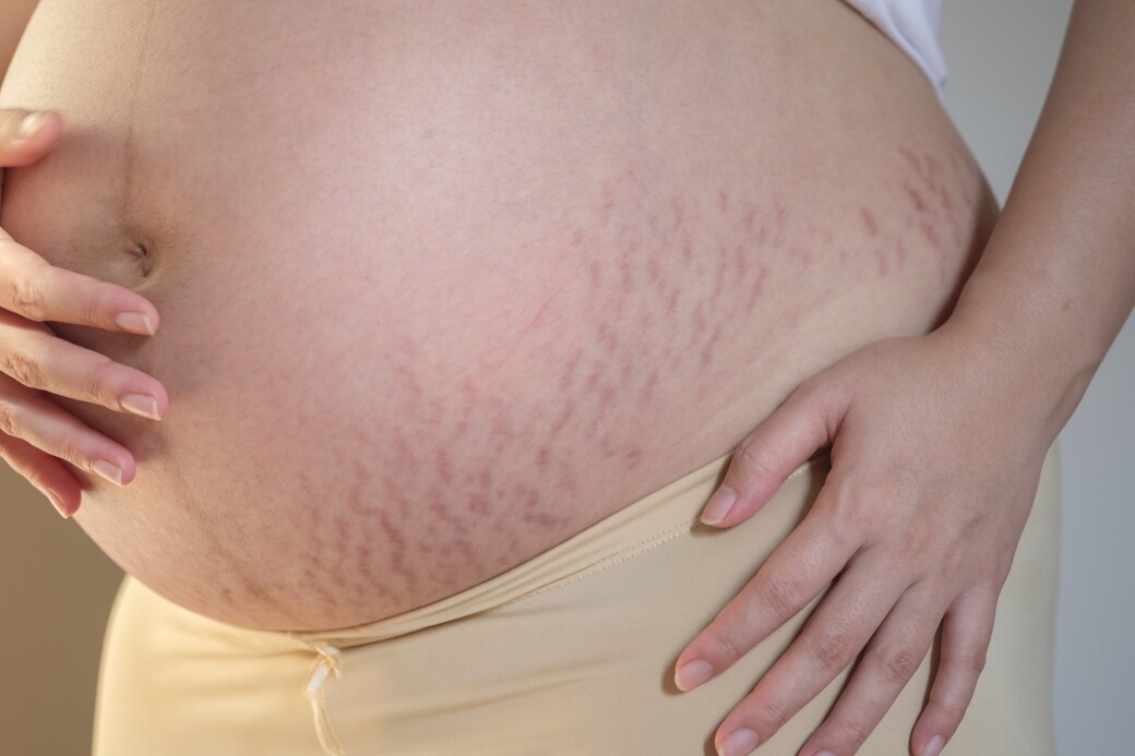 原來並不是每位媽媽都會出現妊娠紋，因為妊娠紋與孕婦自己身體和皮