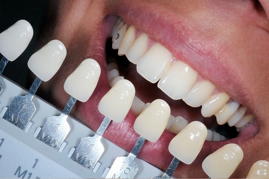 過程首先會以美白劑敷在牙齒表面，再以藍光激活美白劑內成分，滲入牙