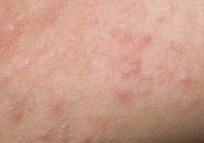 濕疹原因最常見的家族遺傳，濕疹位置是多出現於面、身、手腳、關節位，所以