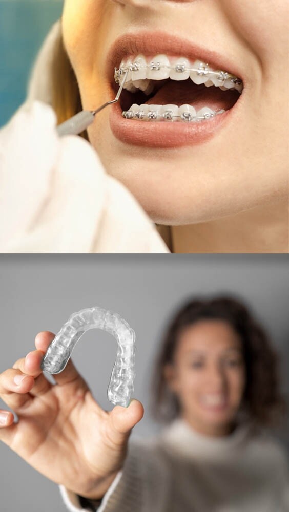 【箍牙價錢2024】透明牙箍、傳統箍牙分別！Zenyum、Beame、隱適美透明牙箍價錢、療程比較！